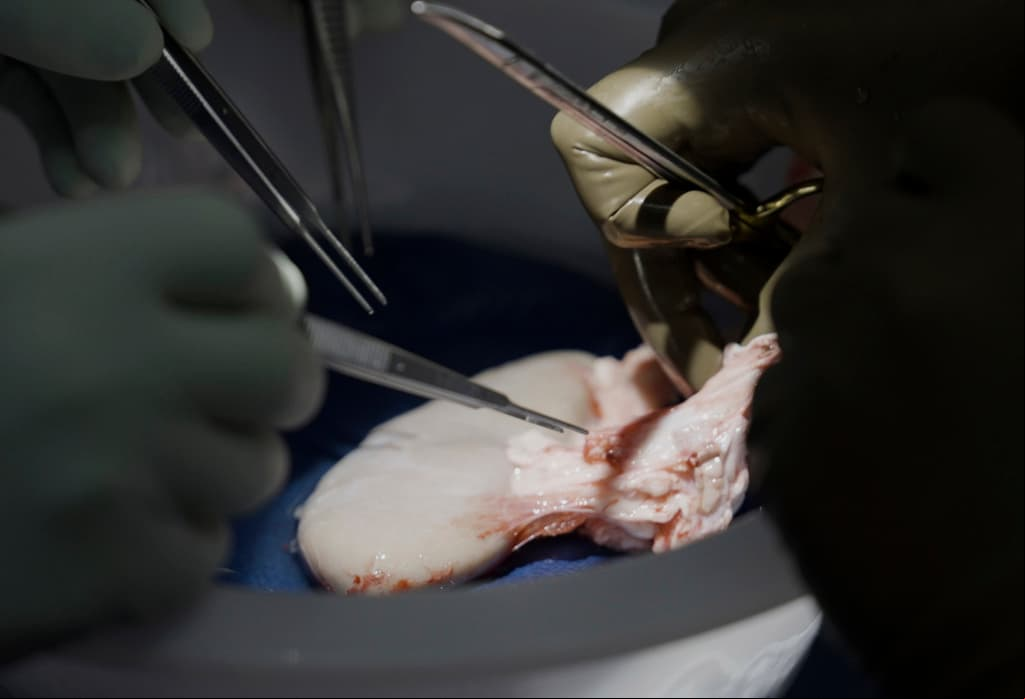 Logro científico: trasplantan un riñón de cerdo a un hombre con muerte cerebral y lleva más de un mes funcionando